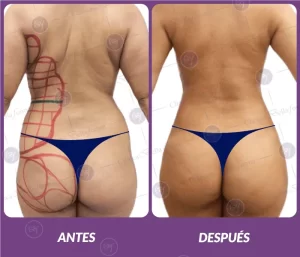 Lipotransferencia 5